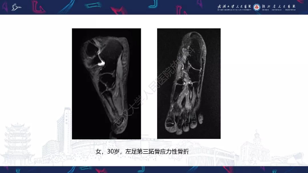 【PPT】踝关节运动损伤MR诊断