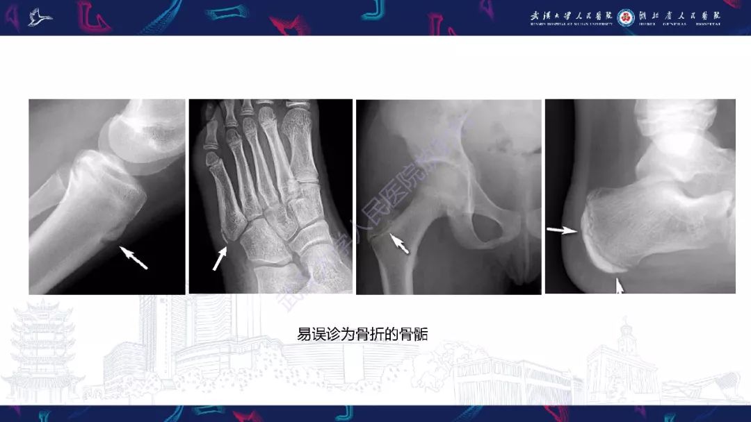 【PPT】踝关节运动损伤MR诊断