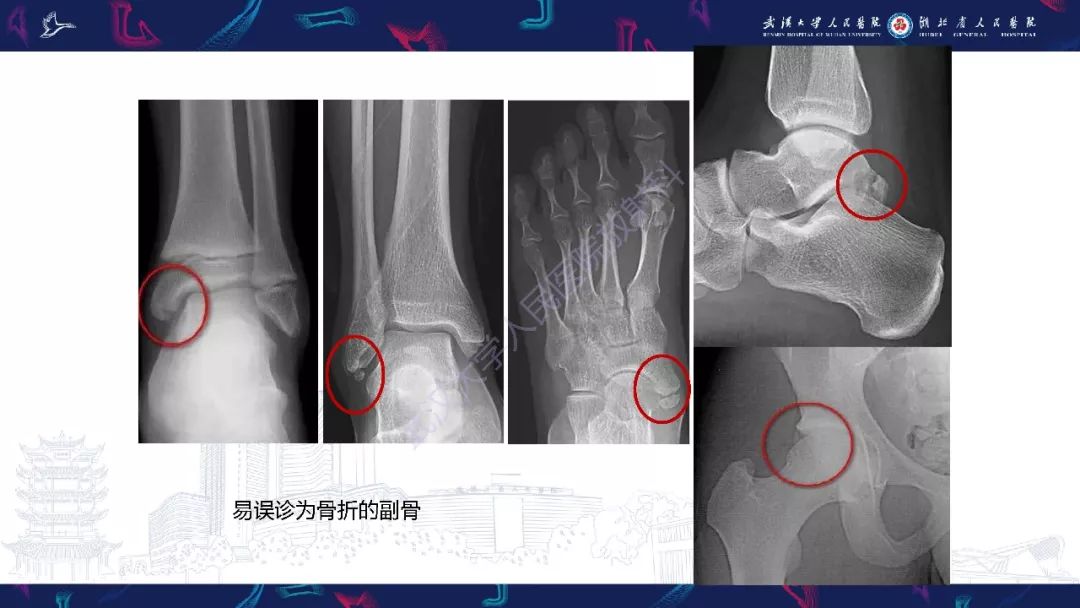 【PPT】踝关节运动损伤MR诊断