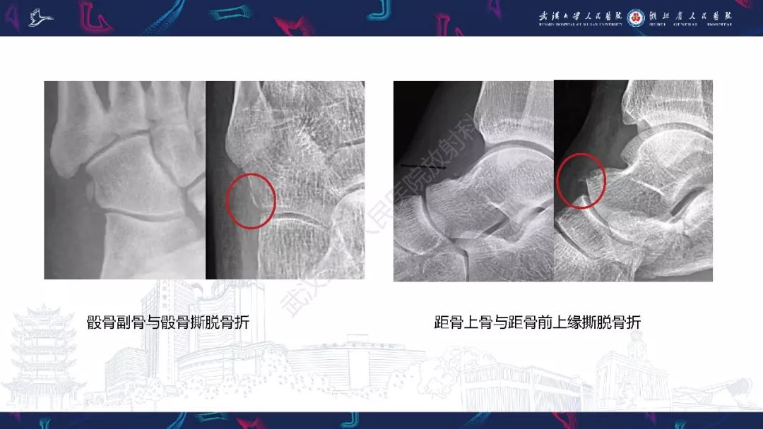 【PPT】踝关节运动损伤MR诊断