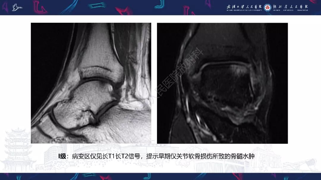 【PPT】踝关节运动损伤MR诊断