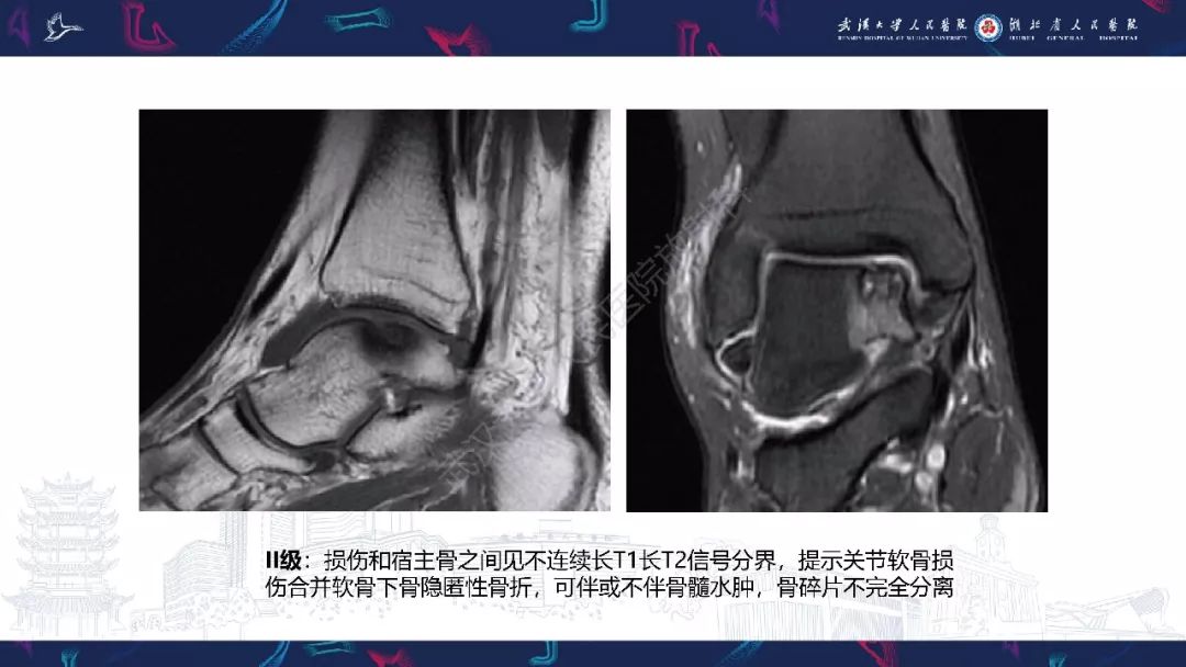 【PPT】踝关节运动损伤MR诊断
