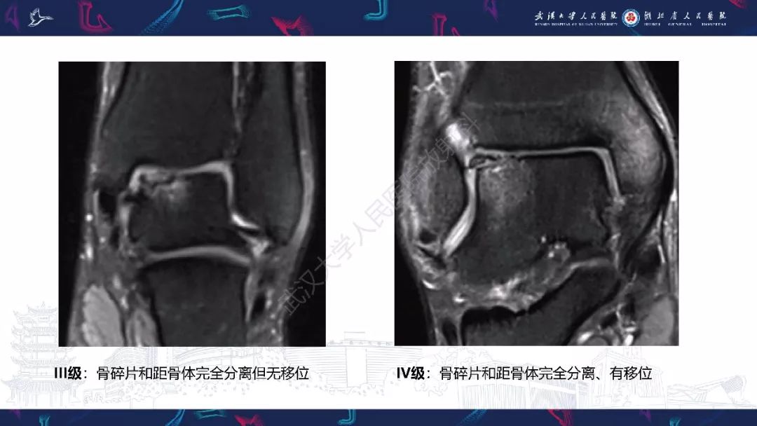 【PPT】踝关节运动损伤MR诊断