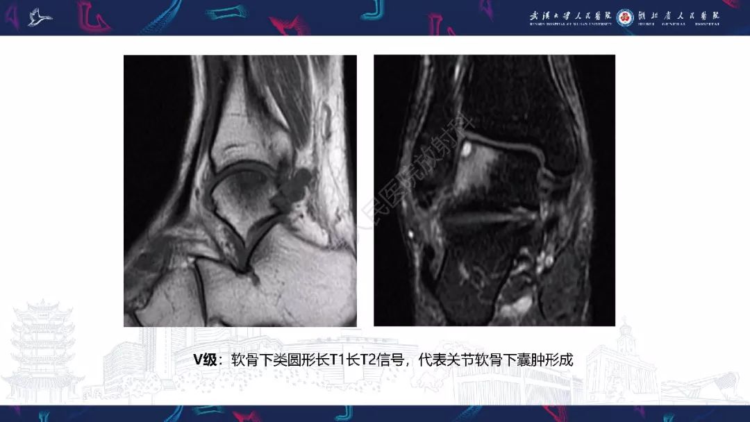 【PPT】踝关节运动损伤MR诊断