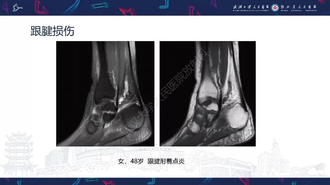 【PPT】踝关节运动损伤MR诊断