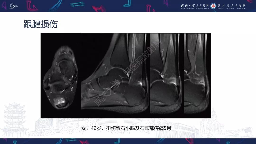 【PPT】踝关节运动损伤MR诊断