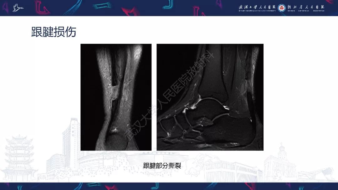 【PPT】踝关节运动损伤MR诊断