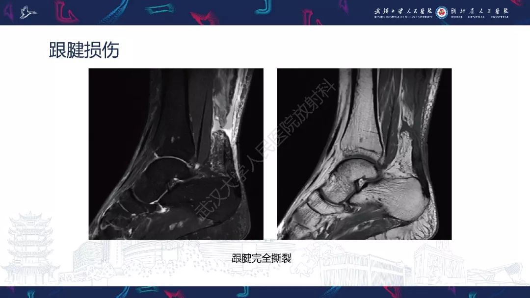 【PPT】踝关节运动损伤MR诊断