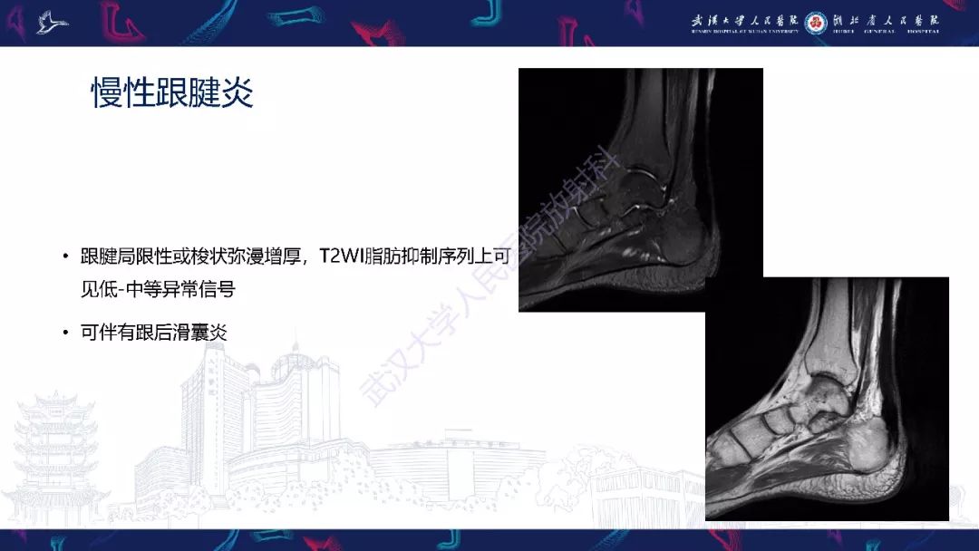 【PPT】踝关节运动损伤MR诊断