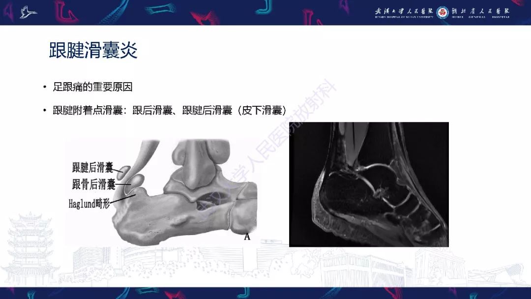 【PPT】踝关节运动损伤MR诊断