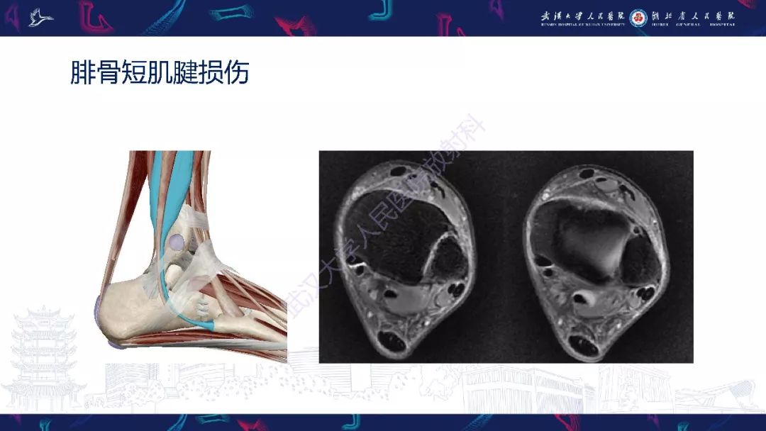 【PPT】踝关节运动损伤MR诊断