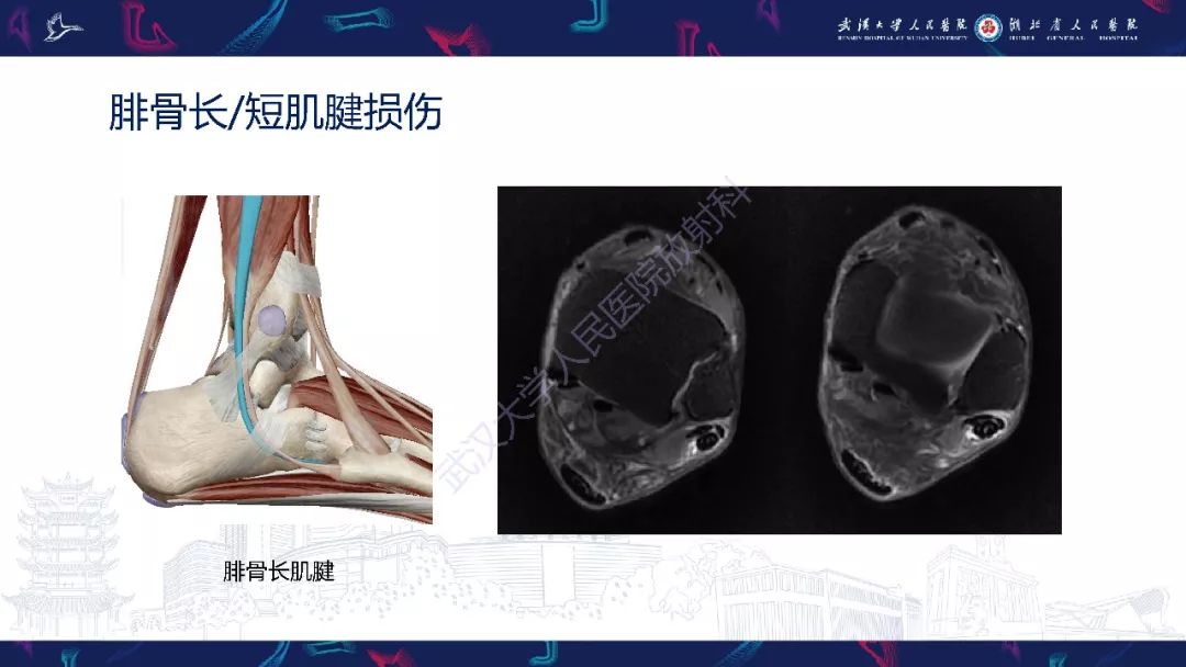 【PPT】踝关节运动损伤MR诊断
