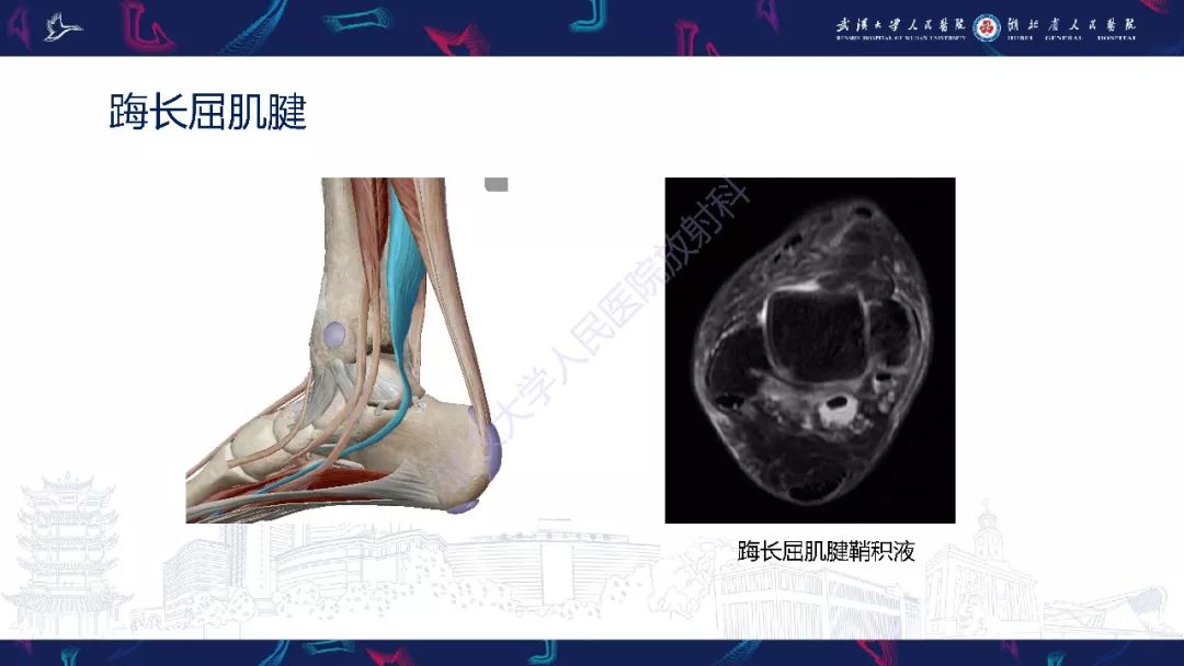【PPT】踝关节运动损伤MR诊断