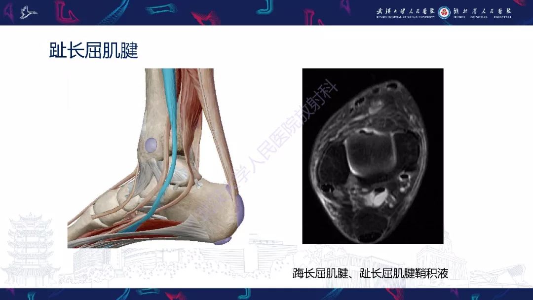 【PPT】踝关节运动损伤MR诊断