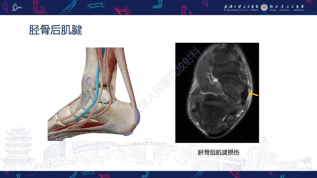 【PPT】踝关节运动损伤MR诊断