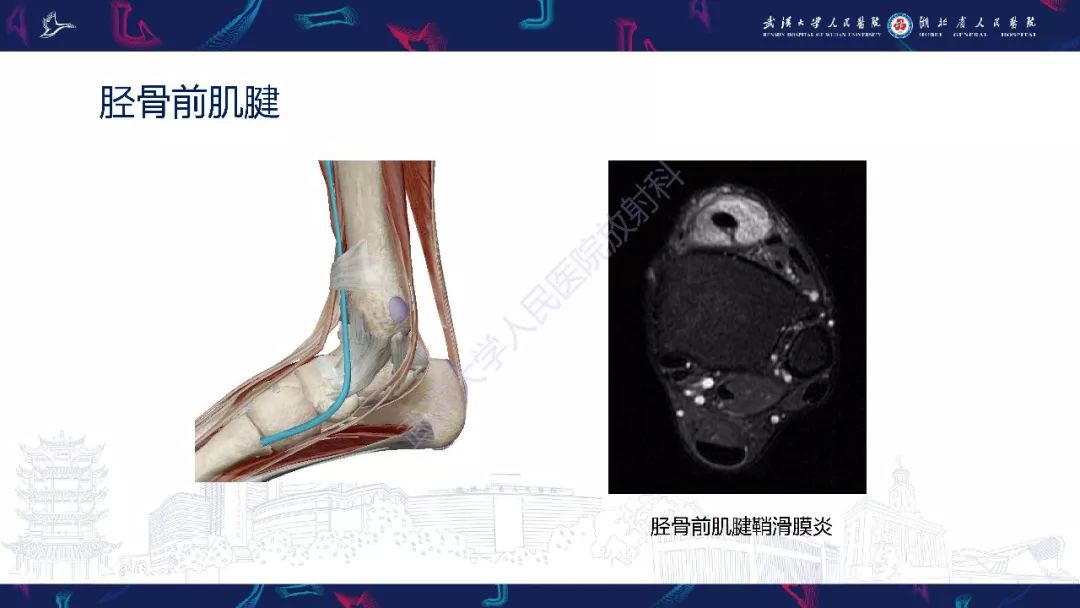 【PPT】踝关节运动损伤MR诊断