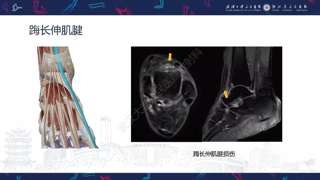 【PPT】踝关节运动损伤MR诊断