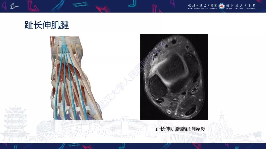 【PPT】踝关节运动损伤MR诊断