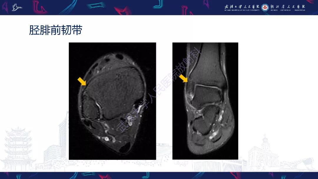 【PPT】踝关节运动损伤MR诊断