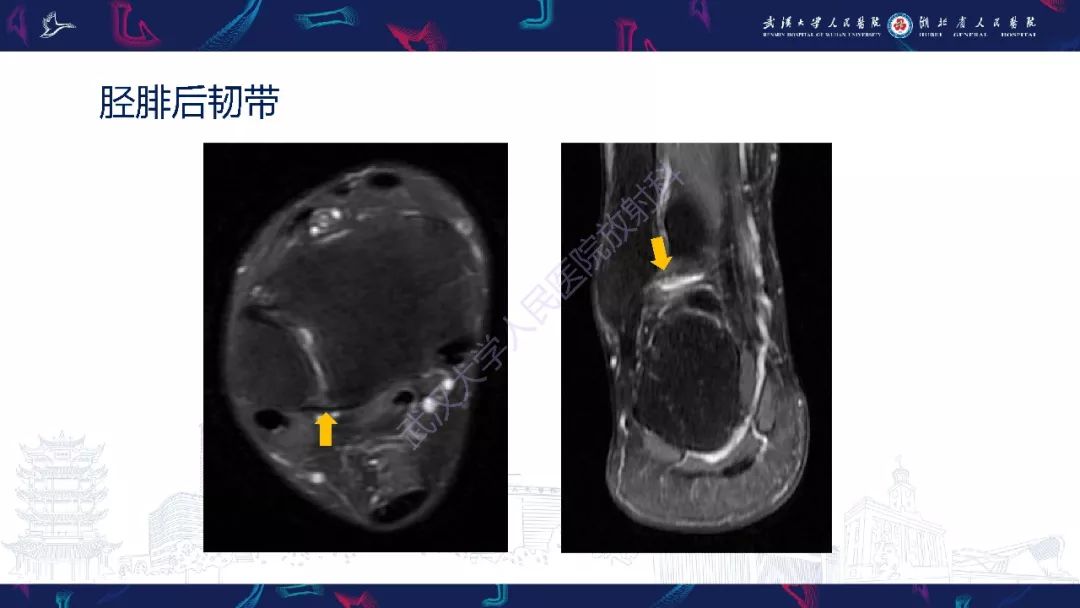 【PPT】踝关节运动损伤MR诊断