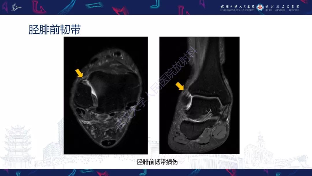 【PPT】踝关节运动损伤MR诊断