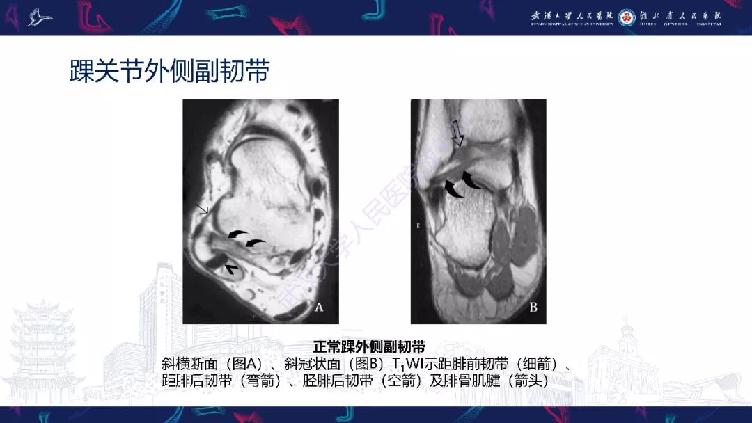【PPT】踝关节运动损伤MR诊断