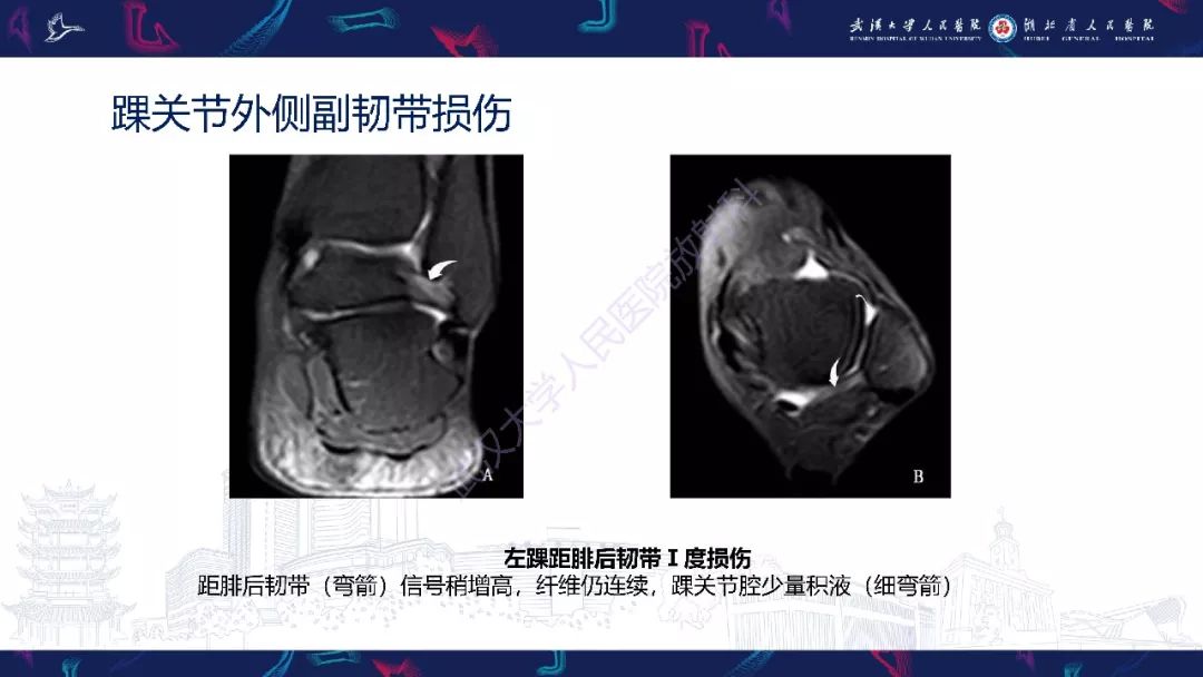 【PPT】踝关节运动损伤MR诊断