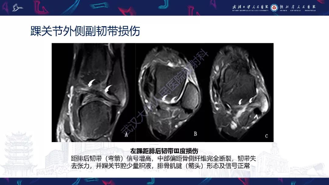 【PPT】踝关节运动损伤MR诊断