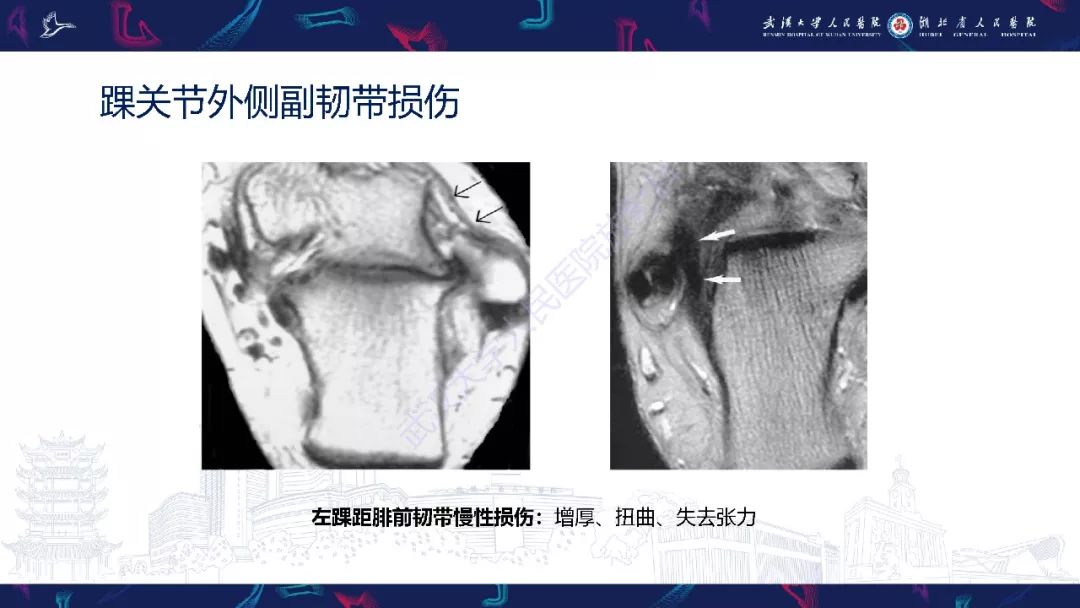 【PPT】踝关节运动损伤MR诊断