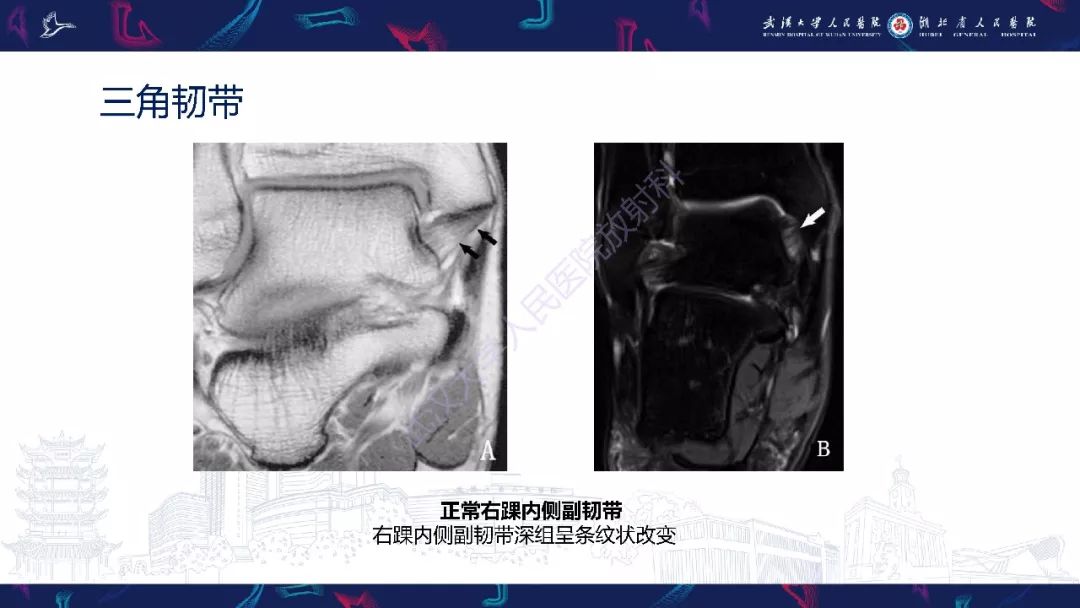 【PPT】踝关节运动损伤MR诊断