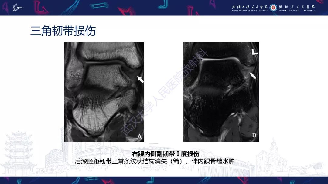 【PPT】踝关节运动损伤MR诊断