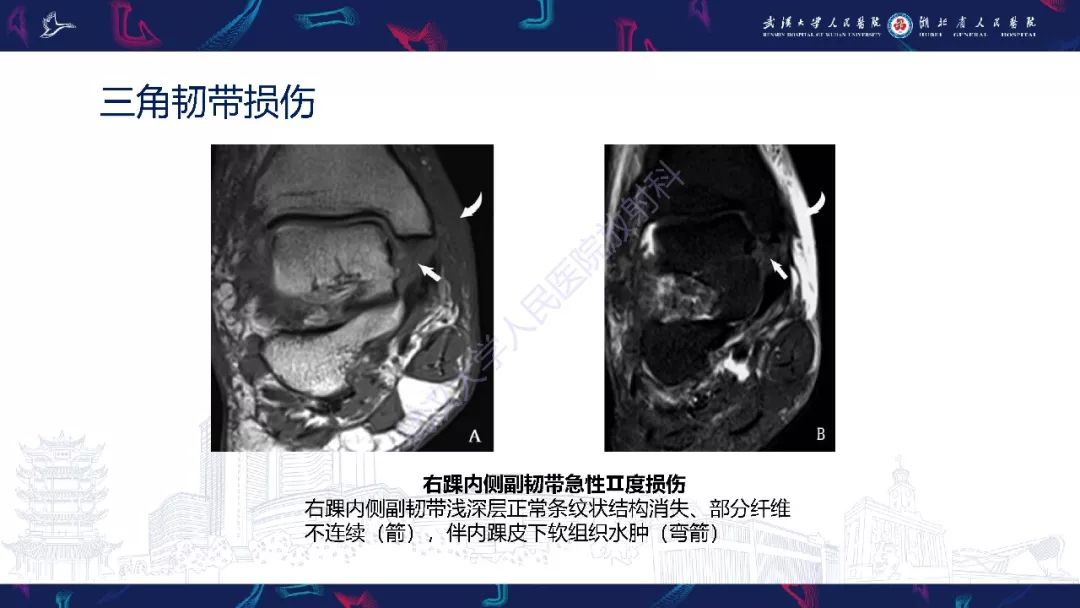 【PPT】踝关节运动损伤MR诊断