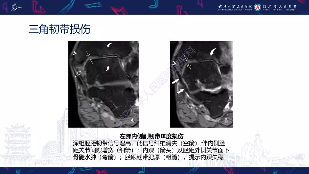 【PPT】踝关节运动损伤MR诊断
