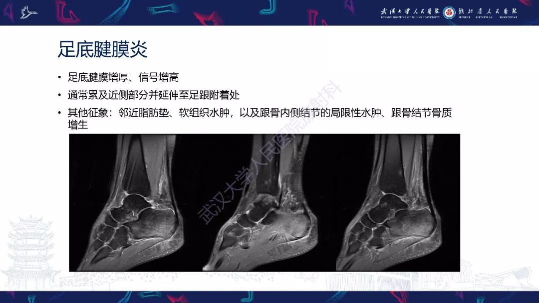 【PPT】踝关节运动损伤MR诊断
