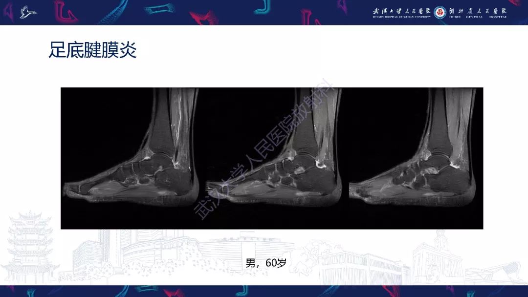 【PPT】踝关节运动损伤MR诊断
