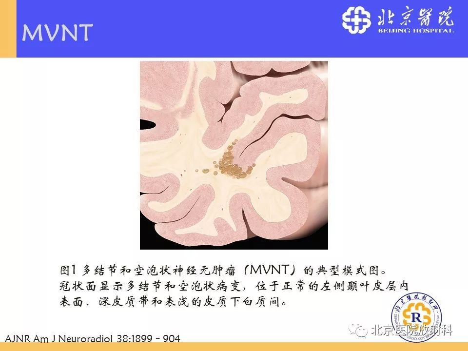 【PPT】多结节和空泡状神经元肿瘤