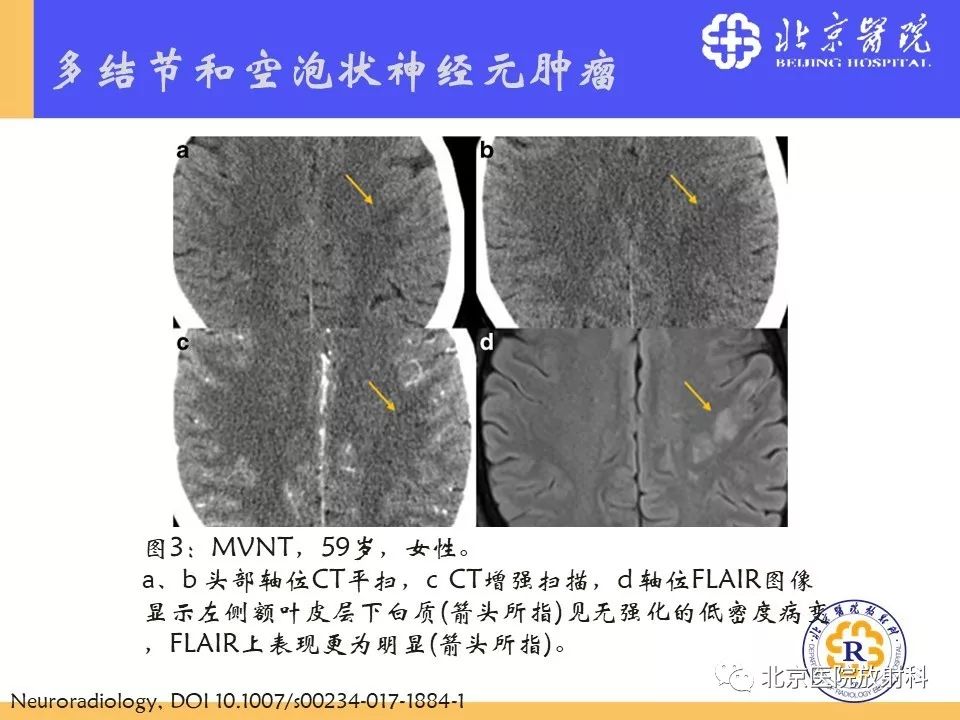 【PPT】多结节和空泡状神经元肿瘤