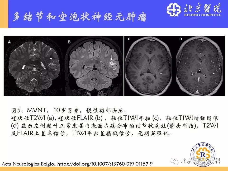 【PPT】多结节和空泡状神经元肿瘤