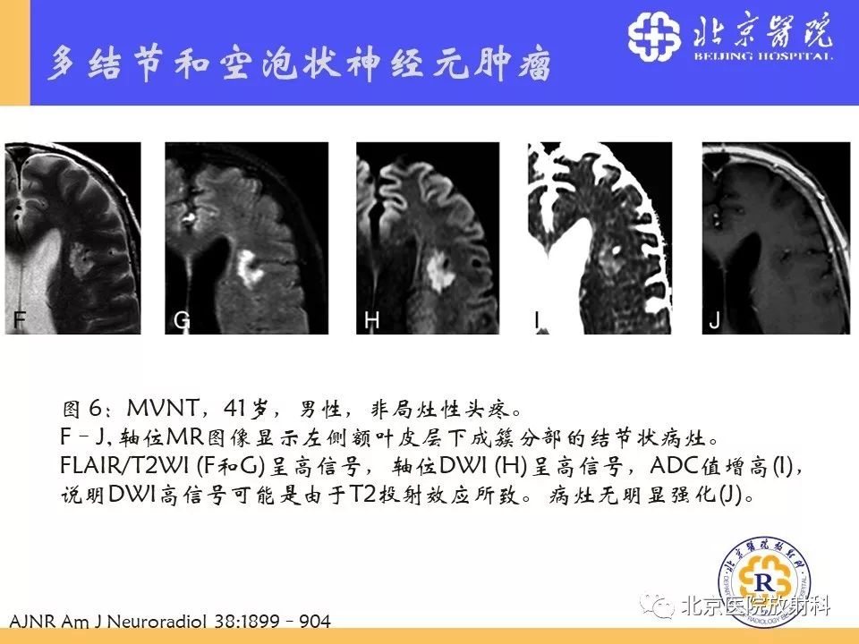 【PPT】多结节和空泡状神经元肿瘤