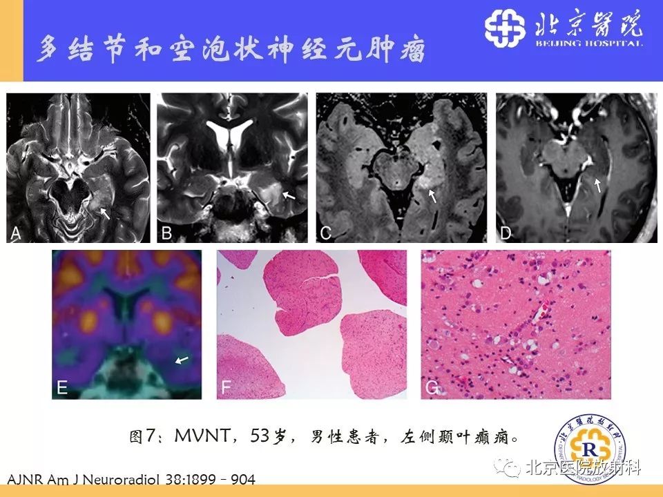 【PPT】多结节和空泡状神经元肿瘤