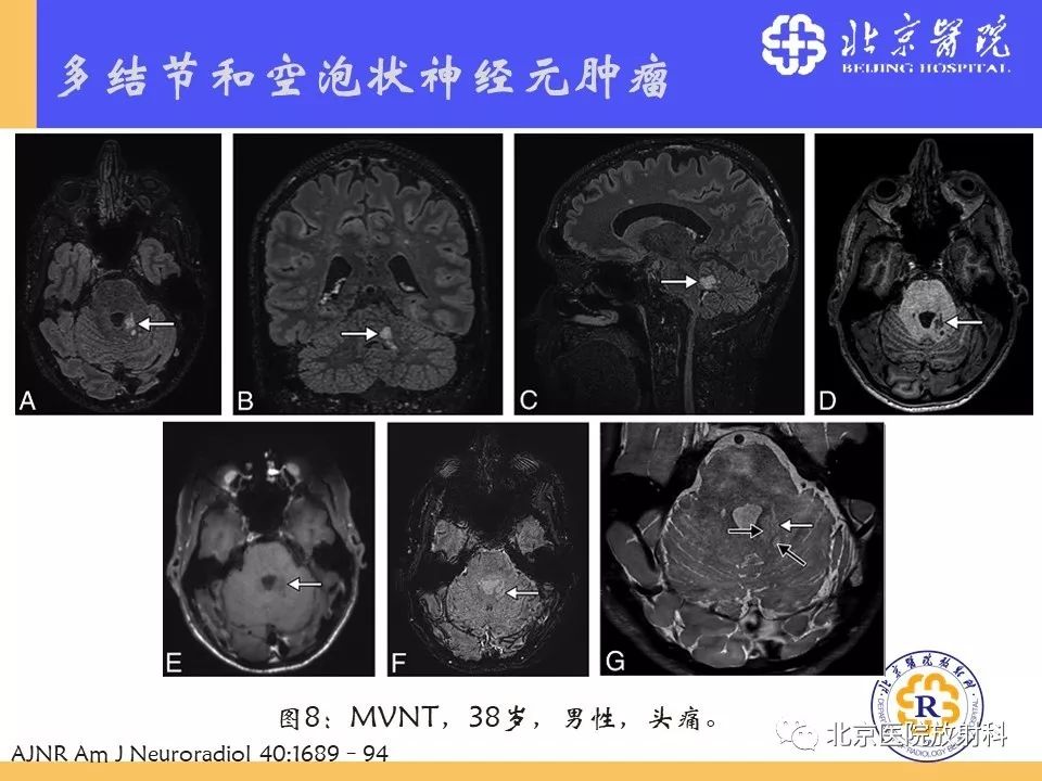 【PPT】多结节和空泡状神经元肿瘤
