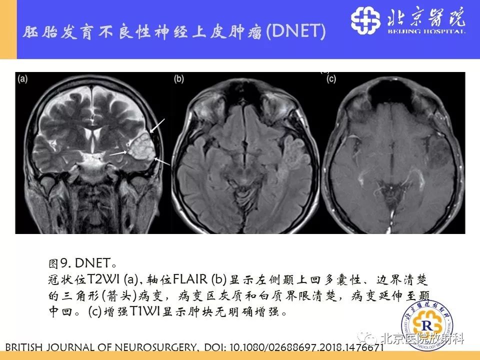 【PPT】多结节和空泡状神经元肿瘤