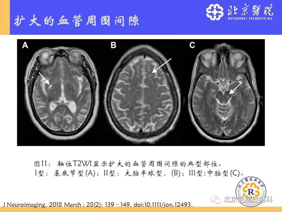 【PPT】多结节和空泡状神经元肿瘤