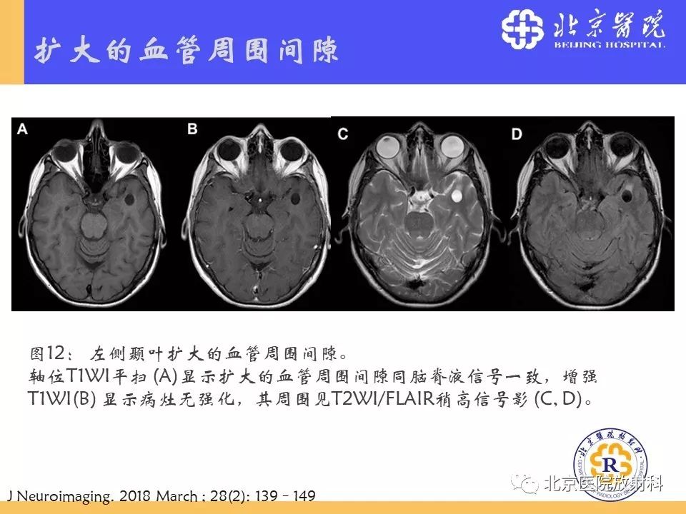 【PPT】多结节和空泡状神经元肿瘤