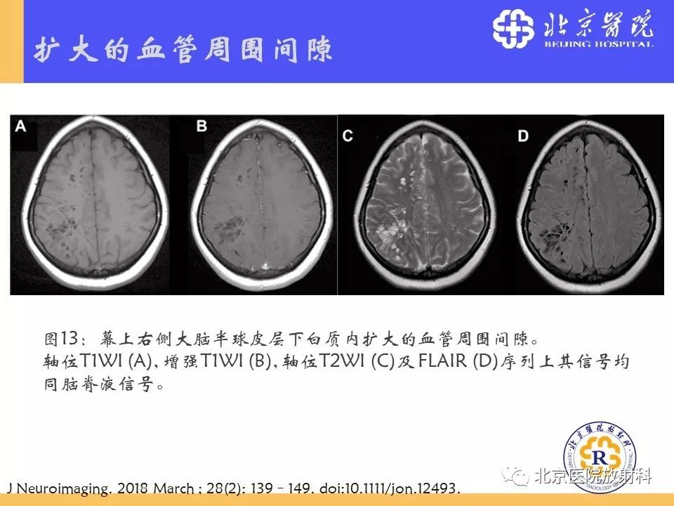 【PPT】多结节和空泡状神经元肿瘤