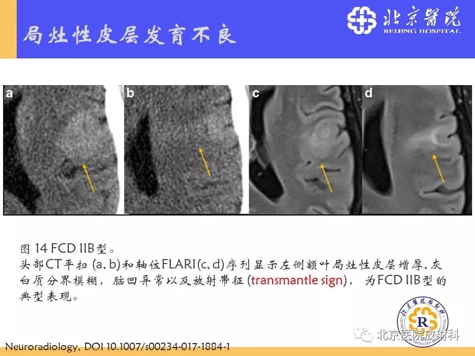 【PPT】多结节和空泡状神经元肿瘤