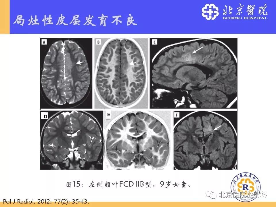 【PPT】多结节和空泡状神经元肿瘤