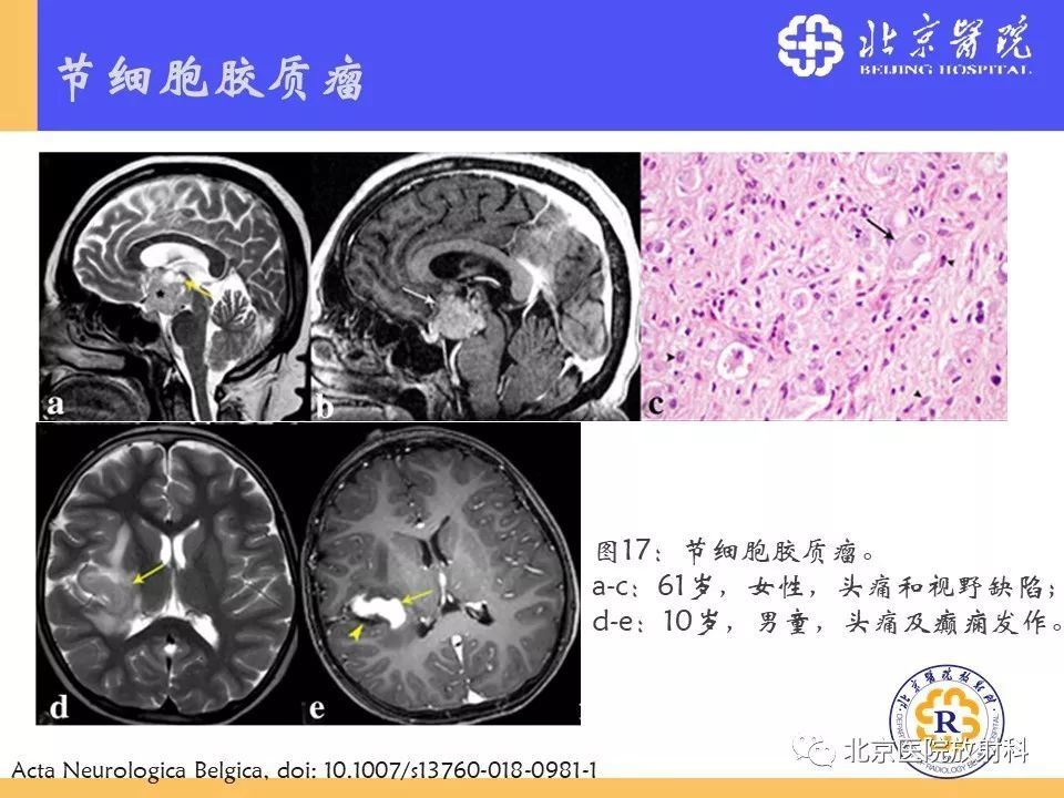 【PPT】多结节和空泡状神经元肿瘤