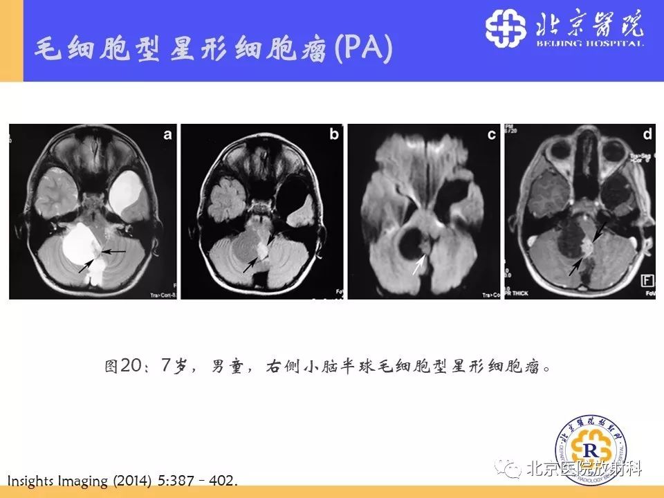【PPT】多结节和空泡状神经元肿瘤