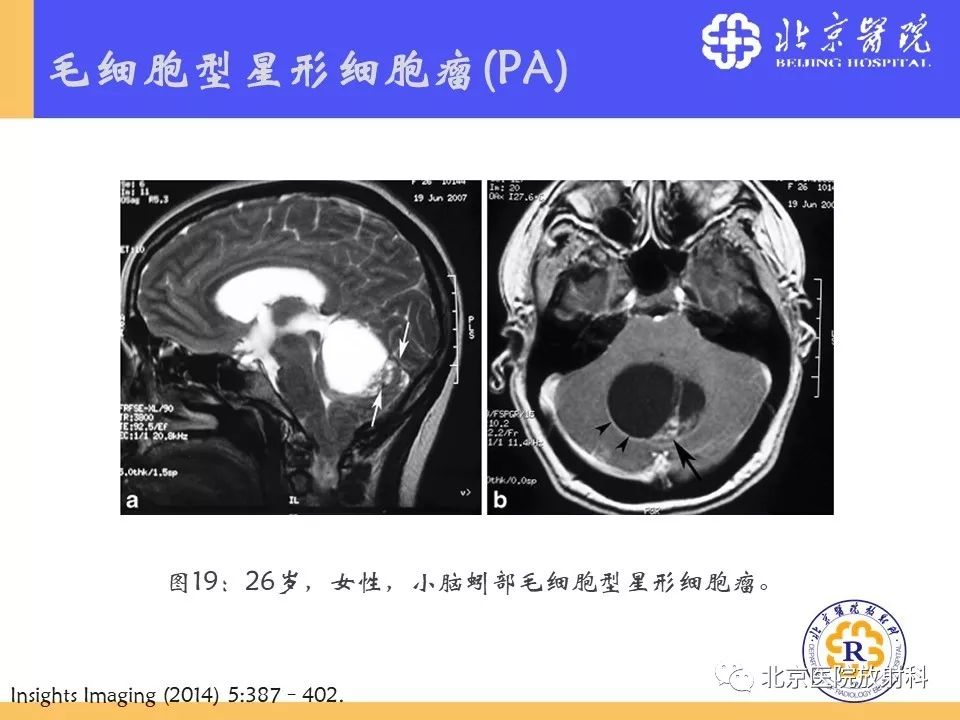 【PPT】多结节和空泡状神经元肿瘤